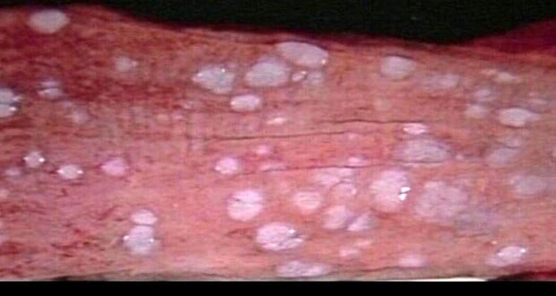 Glycogenic Acanthosis (Esophageal Plaques) – Gluten Free Works