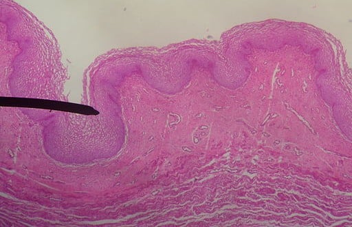 Inflammatory Vaginitis – Gluten Free Works: TREATMENT GUIDE