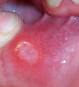 Canker Sore Inside Mouth. Notice The White Spot on This Person's Nail Showing Zinc Deficiency.
