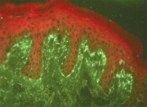 Fluorescence in granular pattern in the basement membrane zone Review: dermatitis herpetiformis An Bras Dermatol. 2013 August;88(4):594-599.