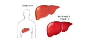 Hepatitis-C-Healthy-Liver-and-Inflammation-of-Liver