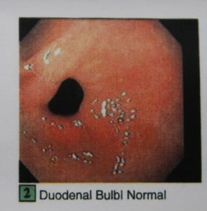 IMG_1006a Duodenal bulb normal
