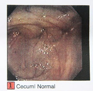 This Is A Normal Cecum (Area Between Small And Large Intetine For Comparison.