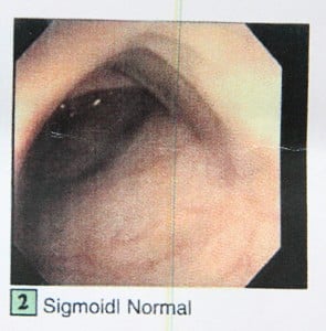 IMG_1010a sigmoid normal