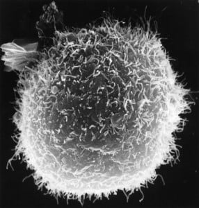 In this impressive photo, the large round cell is a lymphocyte. Macrophages with projectile-looking surfaces are interacting with it. Photo is Courtesy of Dr. Timothy Triche. National Cancer Institute.