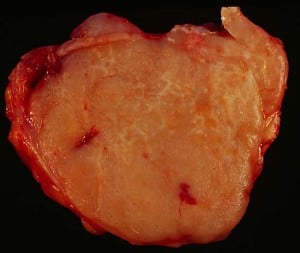 Malignant lymphoma high grade B-cell. Courtesy Wikimedia