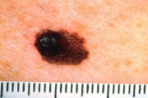 Melanoma. Courtesy wikimedia.com