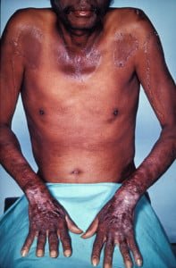 In this photo of a man with pellagra, we see advanced skin alterations: peeling, cracking, sloughing, with blistering, and sore mouth. Note the wasted muscles and white fingernails that indicate protein malnutrition.