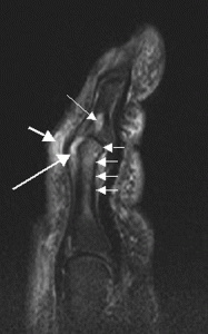 Psoriatic_arthritis_digit_ar1934-2[1]