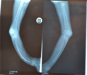 X-ray Of Lower Legs Of A Child With Rickets Due To Undiagnosed Celiac Disease.