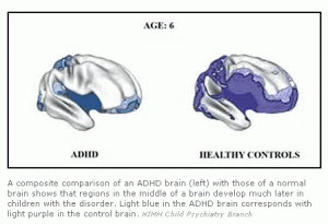 adhd-brain-maturation-dark-areas
