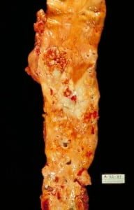 Aorta Diseased by Atherosclerosis.