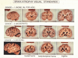 Comparison of Brain Atrophy. Courtesy Source: Source: csua.berkeley.edu    