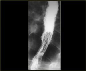 Candida Infection Of The Esophagus on X-ray. Courtesy Radiology Assistant.nl
