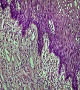 A real photomicrograph of carcinoma of the esophagus. Panorama of 6 photos of a slide at 40x through the microscope. Some areas may appear blurry due to shallow DOF.