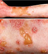Unusual eruptions due to dermatitis herpetiforminis within areas of vitiligo. Courtesy PLOS