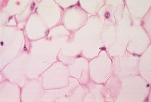Common Yellow Fat composed of adipocytes. Courtesy Pathguy.com.
