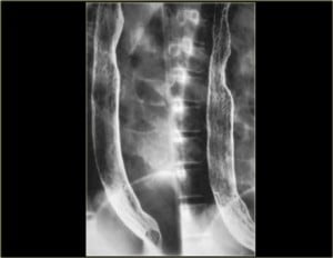  in radiographs (side-by-side) showing appearances of esphagus with glycogenic acanthosis. Courtesy The Radiology Assistant.com