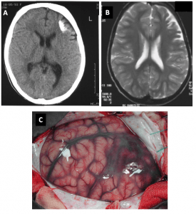 A. CT scan shows coarse calcification. B. MRI shows frontal atrophy. C: Intra-operative leptomeningeal angiomatosis. Courtesy intechopen.com "Epilepsy Surgery in Children" by V. Terra, A, Sakamoto, H. Machado 