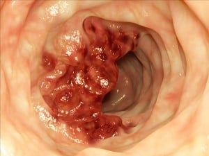 Small Intestinal Tumor