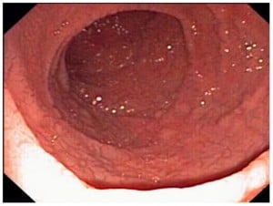 Endoscopy View of Small Bowel in Refractory Celiac Disease.