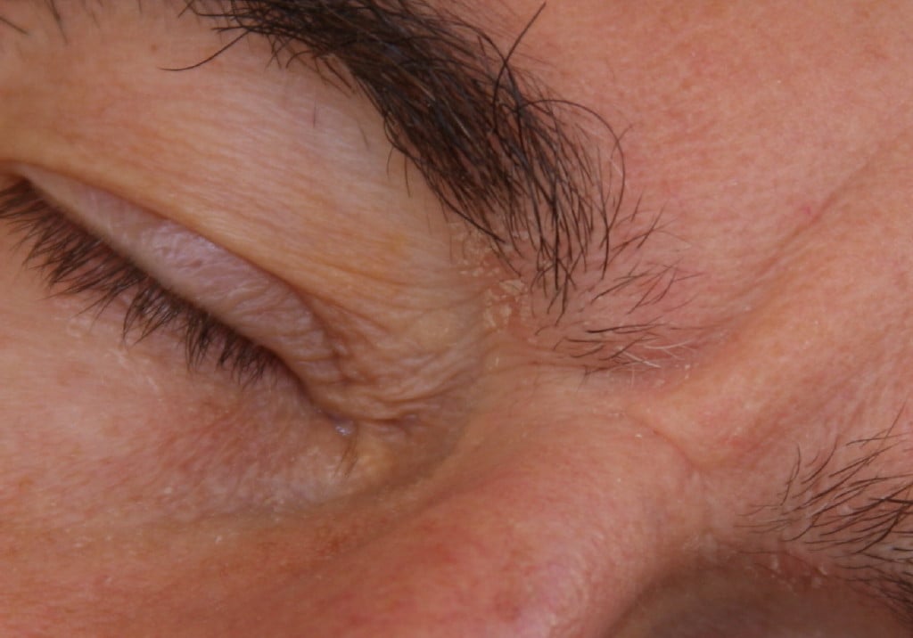Seborrhoeic Dermatitis Eyebrows