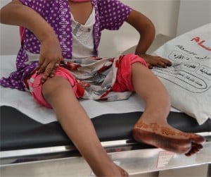 Severe Rickets Caused By Malabsorption In Celiac Disease and/or Gluten Sensitivity. Copyright © Al-Sharafi et al.; licensee BioMed Central Ltd. 2014