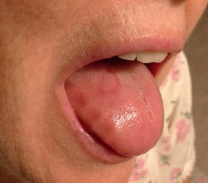 Swollen Tongue Causing Tooth Indentations. GFW