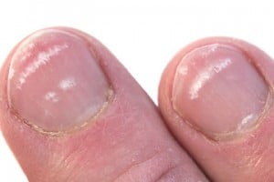 These White Bands Are A Feature Of Protein Deficiency.
