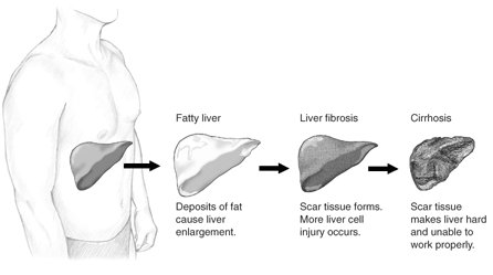 non alcoholic cirrhosis fatty liver celiac disease gluten